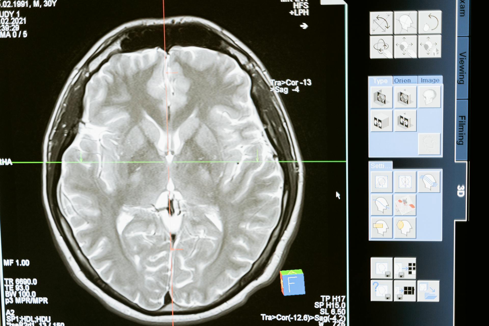 Leia mais sobre o artigo Fragmentos Tóxicos de Proteínas no Cérebro Podem ser Marcadores de Alzheimer em Vida